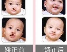 吃兔肉真的會(huì)長(zhǎng)兔唇？為什么會(huì)長(zhǎng)兔唇？